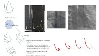 Left ventricular catheterization (including AS) and left ventriculography: Diagrams and cases