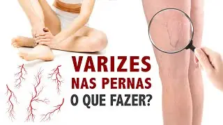 Varizes nas pernas o que fazer?