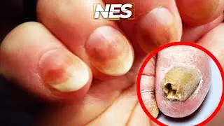 Se as suas UNHAS ficarem assim, CUIDADO! ( pode acontecer com QUALQUER UM)