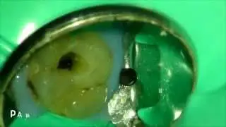 Conservative Access & Obturation of Maxillary 1st Molar