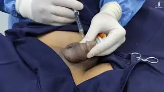 Non-surgical Penile Enlargement 