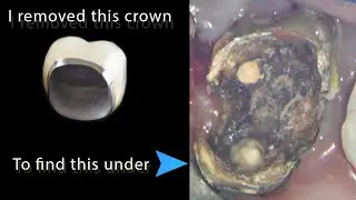 Dental caries hidden under a porcelain fused to metal crown