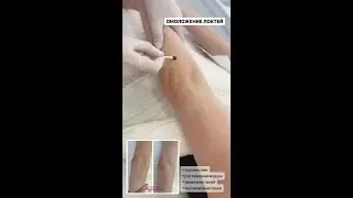 ОМОЛОЖЕНИЕ ЛОКТЕЙ - ВОЗМОЖНО ЛИ ЭТО? 🔥