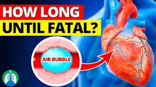 How Long for an Air Embolism to Become Fatal?