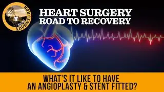 What's it like to have an angioplasty & stent fitted, a patients perspective of heart surgery