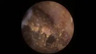 772 - Severe Tinnitus Ear Wax Removal with Jobson Horne