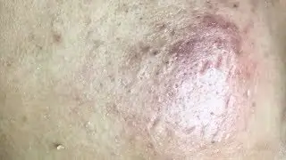 Tokyo Acne Treatment Blackhead Extractions Popping | HaiAu #55