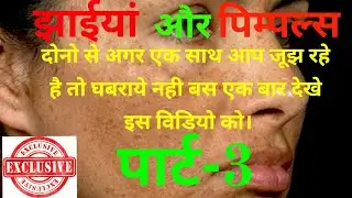झाईयां और पिम्पल्स का उपचार || Melasma || pigmentation || Jhai ki cream || Pimples ||acne