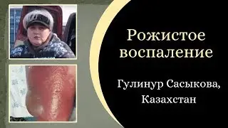 Рожистое воспаление. Результат Гулинур Сасыковой.