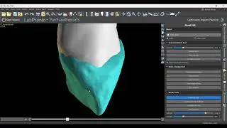 Making Anatomically Accurate Custom Tissue Formers and Immediate Load Implant Crowns