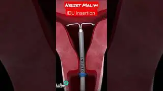 first period after mirena insertion 