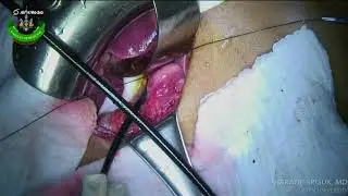 Cholecystectomy and Choledochoduodenostomy