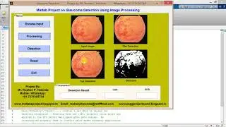Glaucoma Detection using Image Processing FINAL YEAR PROJECT Matlab Project Source Code