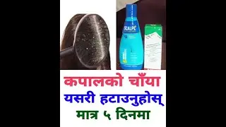 आफ्नो कपाल (टाउको) मा परेको चाँया (Dandruff) मात्र ५ दिनमा हटाउनुहोस्।यी सामानहरु प्रयोग गरि चाँया ह