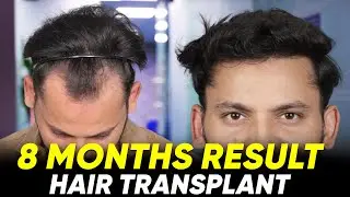 Hair Transplant in France | Best Results & Cost of Hair Transplant in France