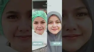 Berikut Video Testimoni Treatment dari Loyal Customer Elzagiarmi Aesthetic Clinic. #shorts