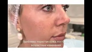 Микроигольчатый RF лифтинг INUS