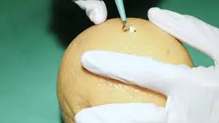 Die Tangentiale Abtragung/ Curettage am Beispiel einer Apfelsine