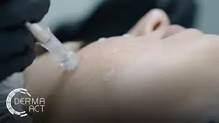 Микронидлинг в Derma-Act