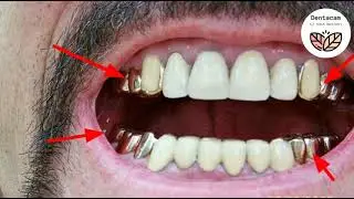 Best quality tooth cap in hindi | dental caps