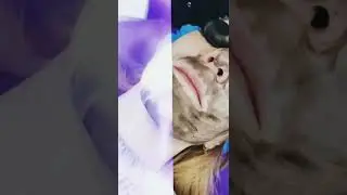 Карбоновый пилинг, карбоный пилинг Киев, косметология