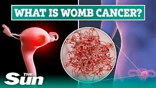 Womb cancer symptoms most women ignore