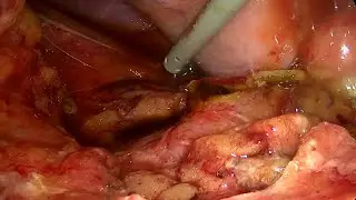 Riparazione Laparoscopica di Fistola Duodenale precoce dopo Gastrectomia Subtotale Laparoscopica