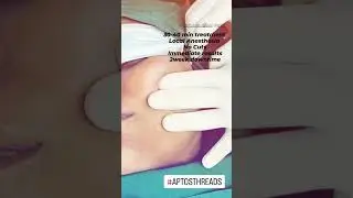 Aptos Thread Lift for skin tightening at Dr. Karishma Aesthetics the best cosmetic clinic Bengaluru