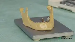 Установка дентальных имплантатов Straumann BL