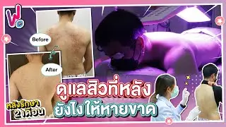 รีวิวพลีชีพ I รักษาสิวที่หลัง  6 ขั้นตอนสูตรพิเศษ!! สิวอักเสบ สิวอุดตัน ให้หายขาด