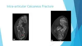 Calcaneus Fracture