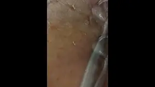 Hair Ingrown that turns into a blackhead