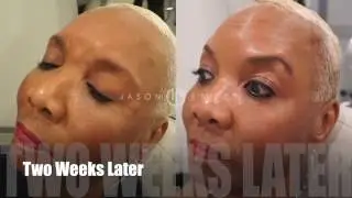 Botox Injection Step-By-Step | Neurotoxin for Crow's Feet | Wrinkles Lines Forehead and Eyes