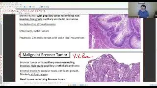 GYN PATHOLOGY: OVARIAN TUMORS 2