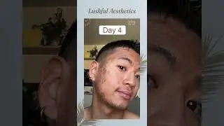 Chemical Peel