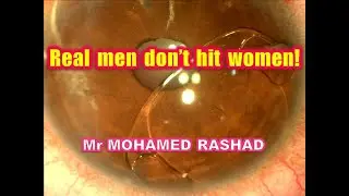 Secrets of Reposition of dislocated Artisan iris claw phakic intraocular lensجراحة عدسات داخل العين