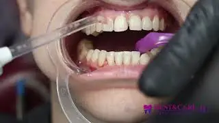 Cum se face igienizarea spatiilor interdentare