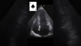 Apical HCM #pocus #emergencymedicine #echofirst