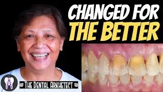 Digitally Guided Direct Composite Veneer 