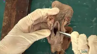 H&N Part 2 Larynx