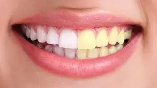 DIENTES BLANCOS CON VINAGRE , REMEDIO CASERO | RAPIDO Y ECONOMICO | CINDYLIMON