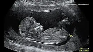 This is What Babies Kicking in the Womb are Really Doing