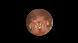 Врожденный стеноз подголосового отдела гортани / Congenital subglottic stenosis