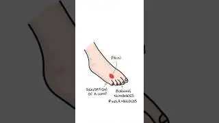 Morton's Neuroma #medicine #medicine #orthopaedics
