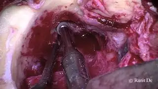 Excision and repair of Brain hernia in mastoid cavity
