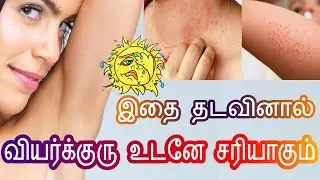 வியர்க்குரு மறைய சில எளிய டிப்ஸ் | How to get rid of Prickly Heat|Verkuru tips|Tamil Beauty Tips