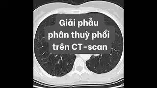 Giải phẫu phân thuỳ phổi trên CT