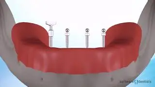 Overdenture operations with balls