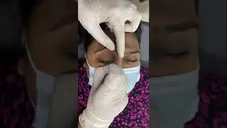 Sebaceous cyst removal very close to the eye. Follow on insta @dermatologist.drsonam #pimplepopper
