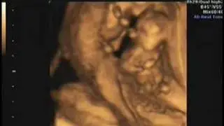 Texas Quints - Week 12 Ultrasound with Quintuplets